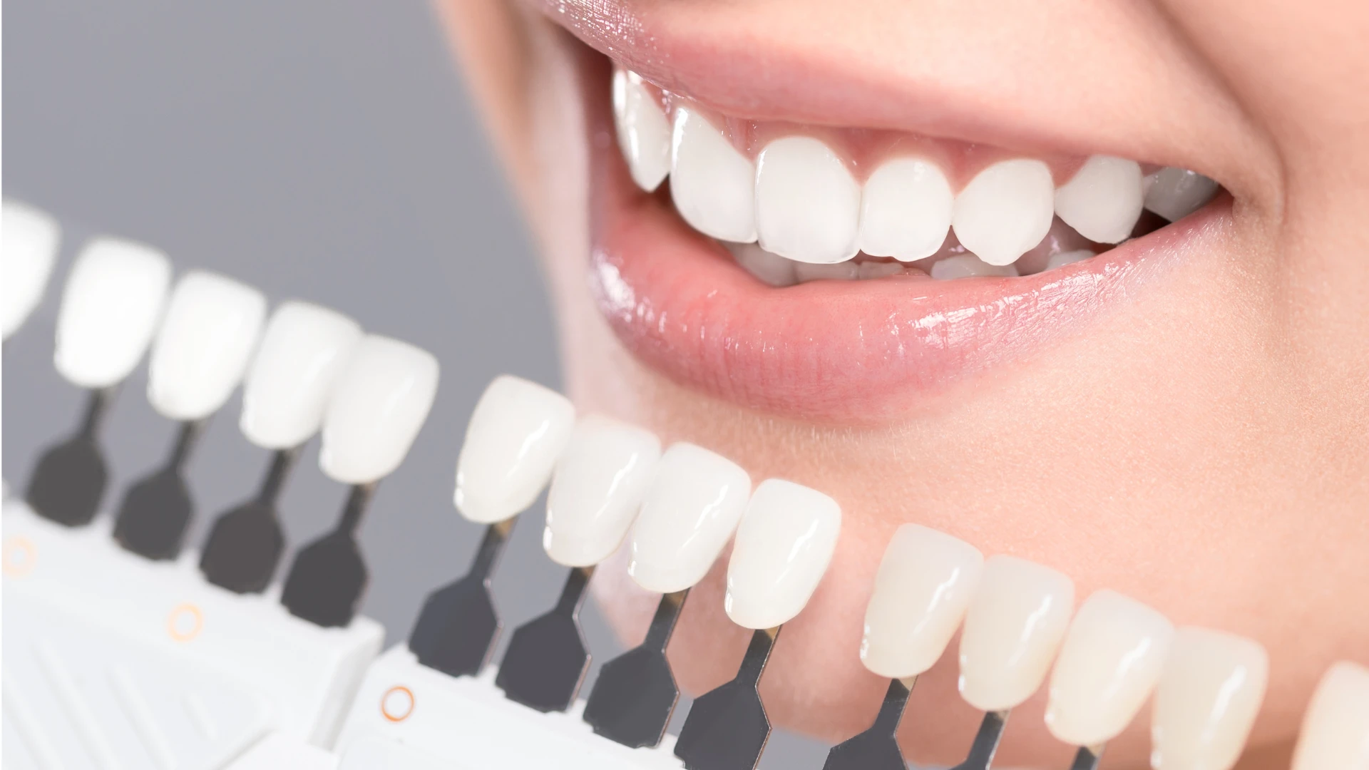 Professional Whitening - VITA shade comparison